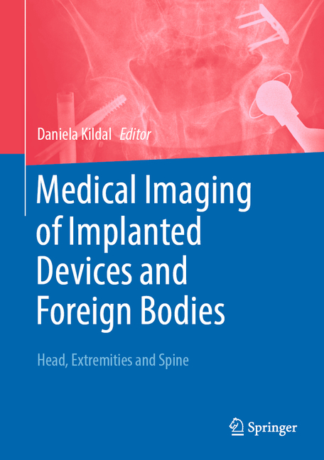 Medical Imaging of Implanted Devices and Foreign Bodies: Head, Extremities and Spine (2024)