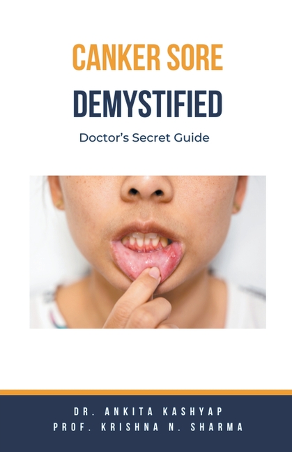 Canker Sore Demystified: Doctor's Secret Guide